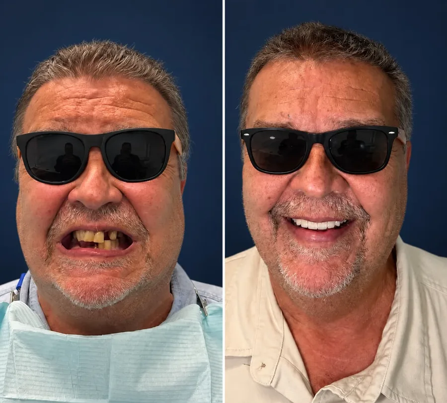 Before and after smile design case at Altamar Dental Studio in Naples, FL