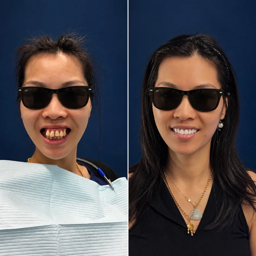 Before and after smile design case at Altamar Dental Studio in Naples, FL