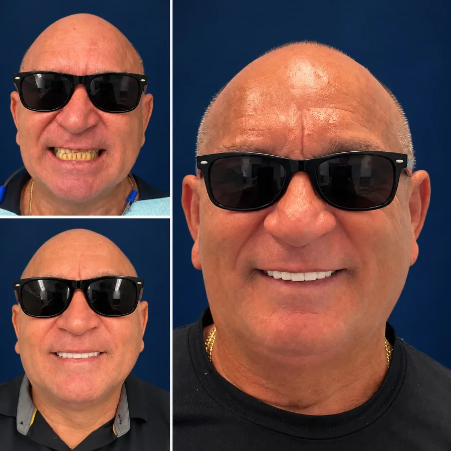 Smile design case at Altamar Dental Studio in Naples, FL showing before, temporaries, and final result
