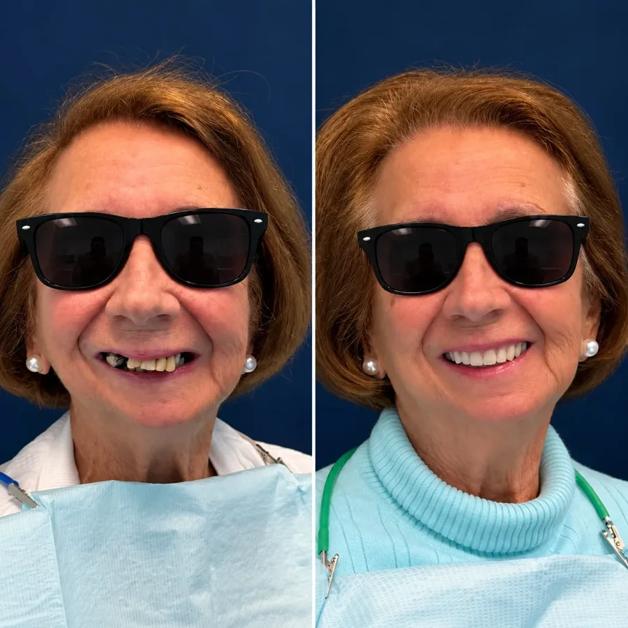 Before and after smile design case at Altamar Dental Studio in Naples, FL