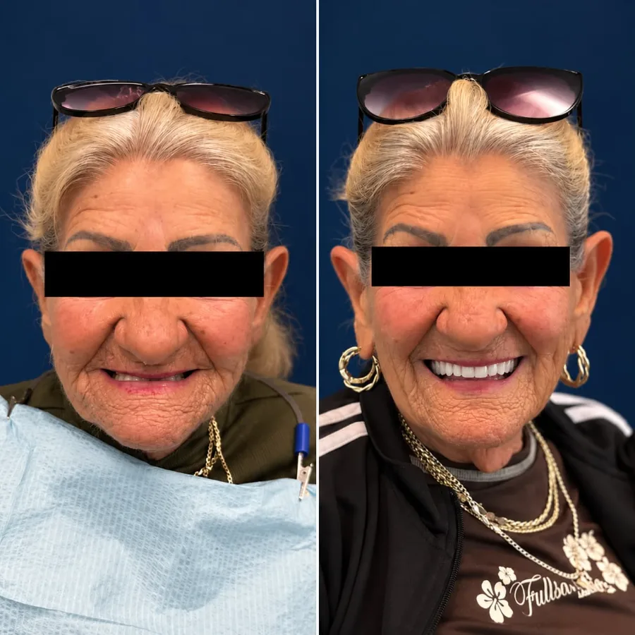 Before and after smile design case at Altamar Dental Studio in Naples, FL