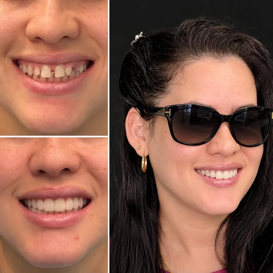 Smile design case at Altamar Dental Studio in Naples, FL showing before, temporaries, and final result