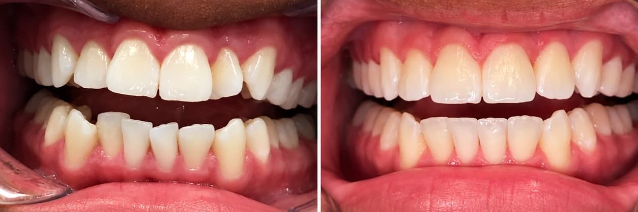 Close-up before and after of a patient's teeth after Invisalign treatment at Altamar Dental Studio in Naples, FL
