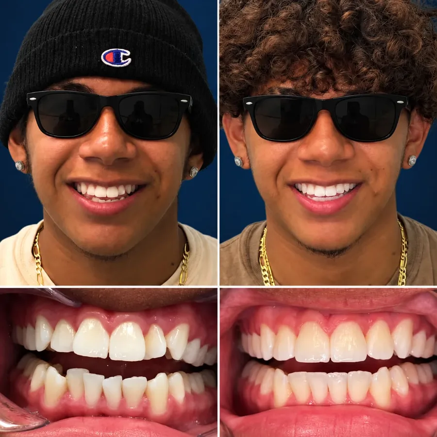 Invisalign before and after at Altamar Dental Studio in Naples, FL