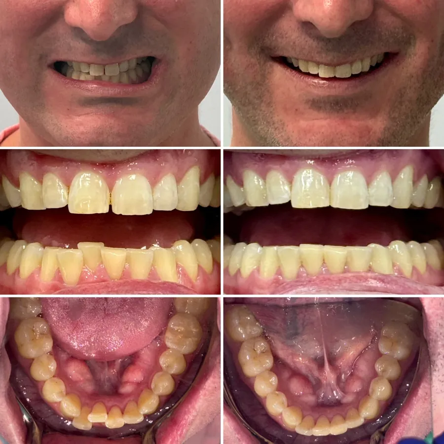 Invisalign before and after at Altamar Dental Studio in Naples, FL