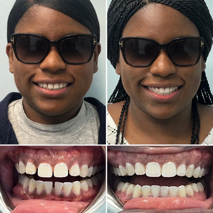 Invisalign before and after at Altamar Dental Studio in Naples, FL