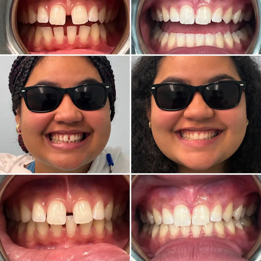 Invisalign before and after at Altamar Dental Studio in Naples, FL