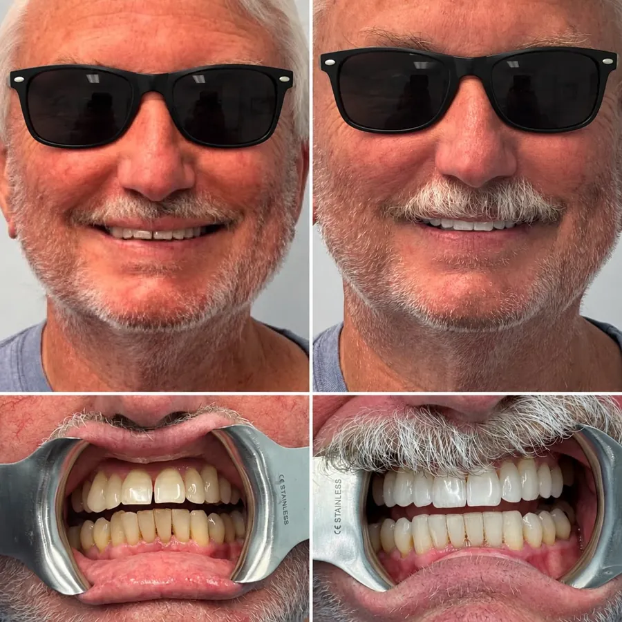 Invisalign before and after at Altamar Dental Studio in Naples, FL