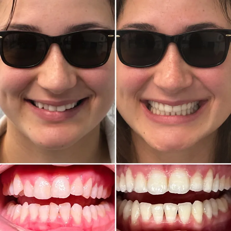 Invisalign before and after at Altamar Dental Studio in Naples, FL