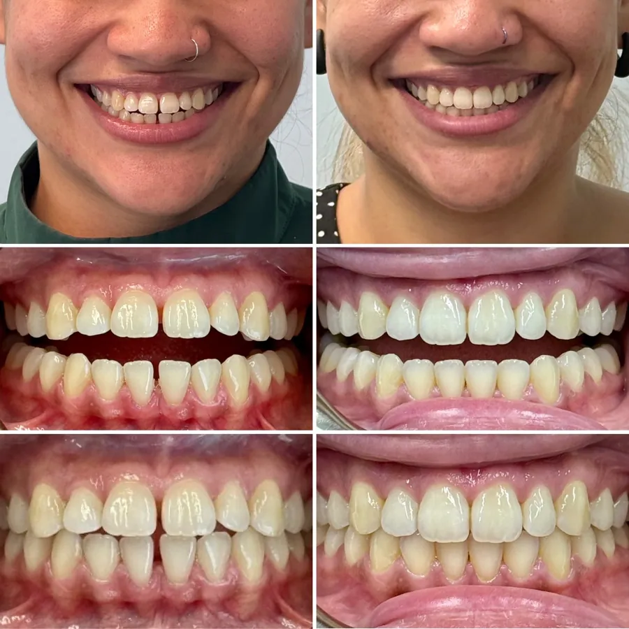Invisalign before and after at Altamar Dental Studio in Naples, FL