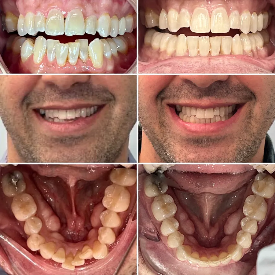 Invisalign before and after at Altamar Dental Studio in Naples, FL