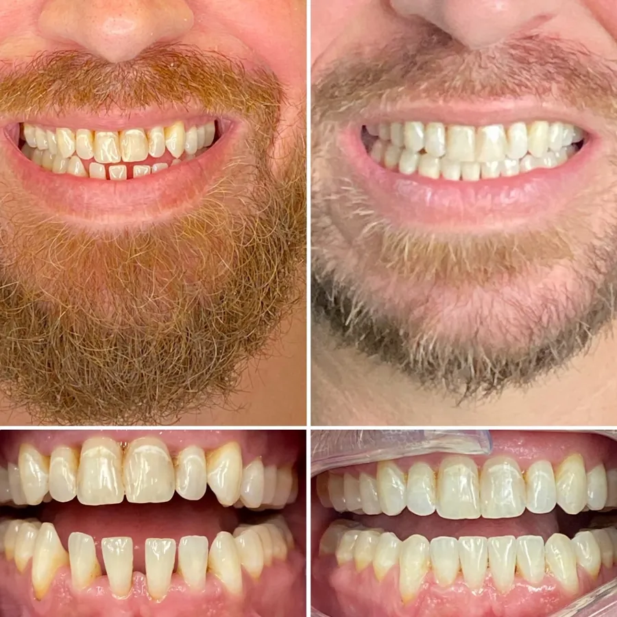 Invisalign before and after at Altamar Dental Studio in Naples, FL