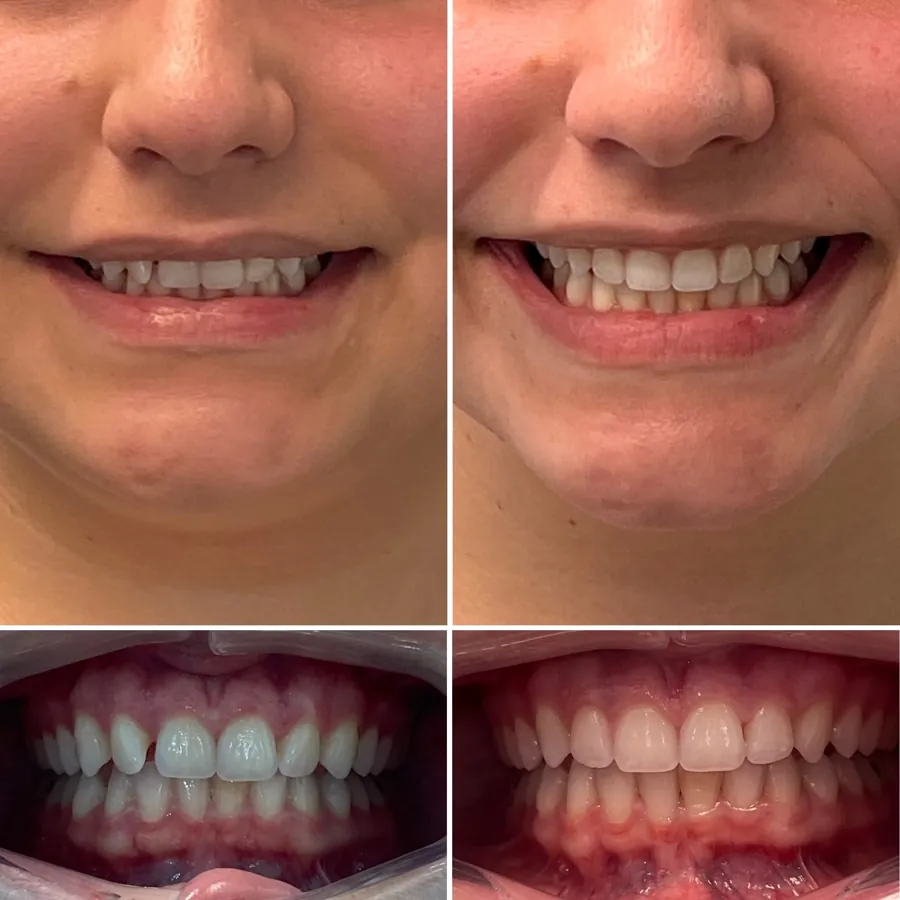 Invisalign before and after at Altamar Dental Studio in Naples, FL