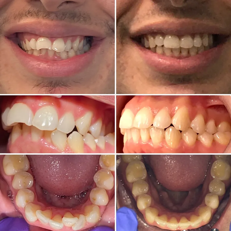 Invisalign before and after at Altamar Dental Studio in Naples, FL