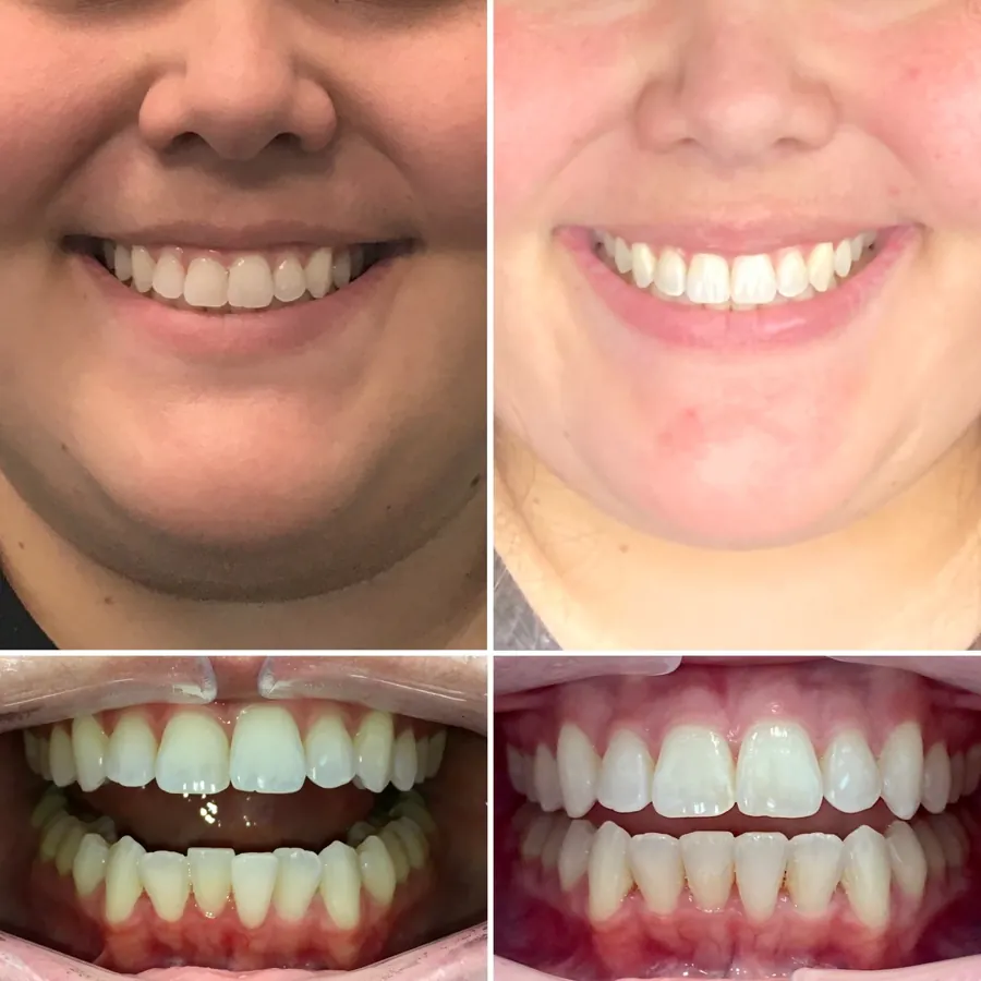 Invisalign before and after at Altamar Dental Studio in Naples, FL