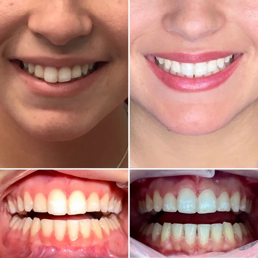 Invisalign before and after at Altamar Dental Studio in Naples, FL